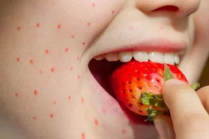 la-alergia-a-los-alimentos-esta-relacionada-con-la-exposicion-a-la-piel-4852
